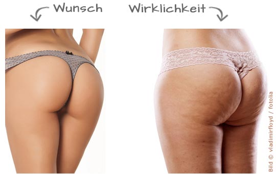 An wie bekomme ich weg beinen cellulite den Anti Cellulite